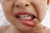 孩子“牙疼”起皮疹疱疹　或是手足口病作祟